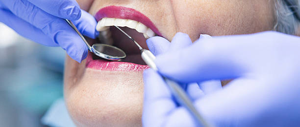 Best Emergency Wisdom Tooth Extraction in USA